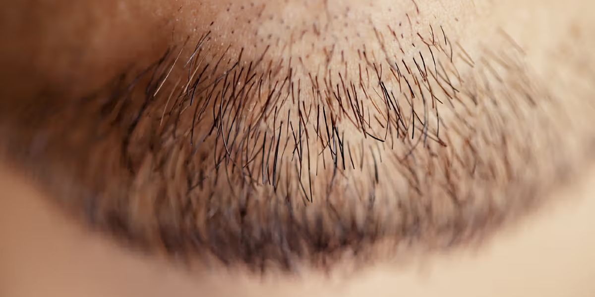 Beard Hair Loss: Causes and Solutions